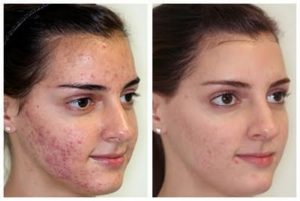 LED Therapy May Cure Acne 